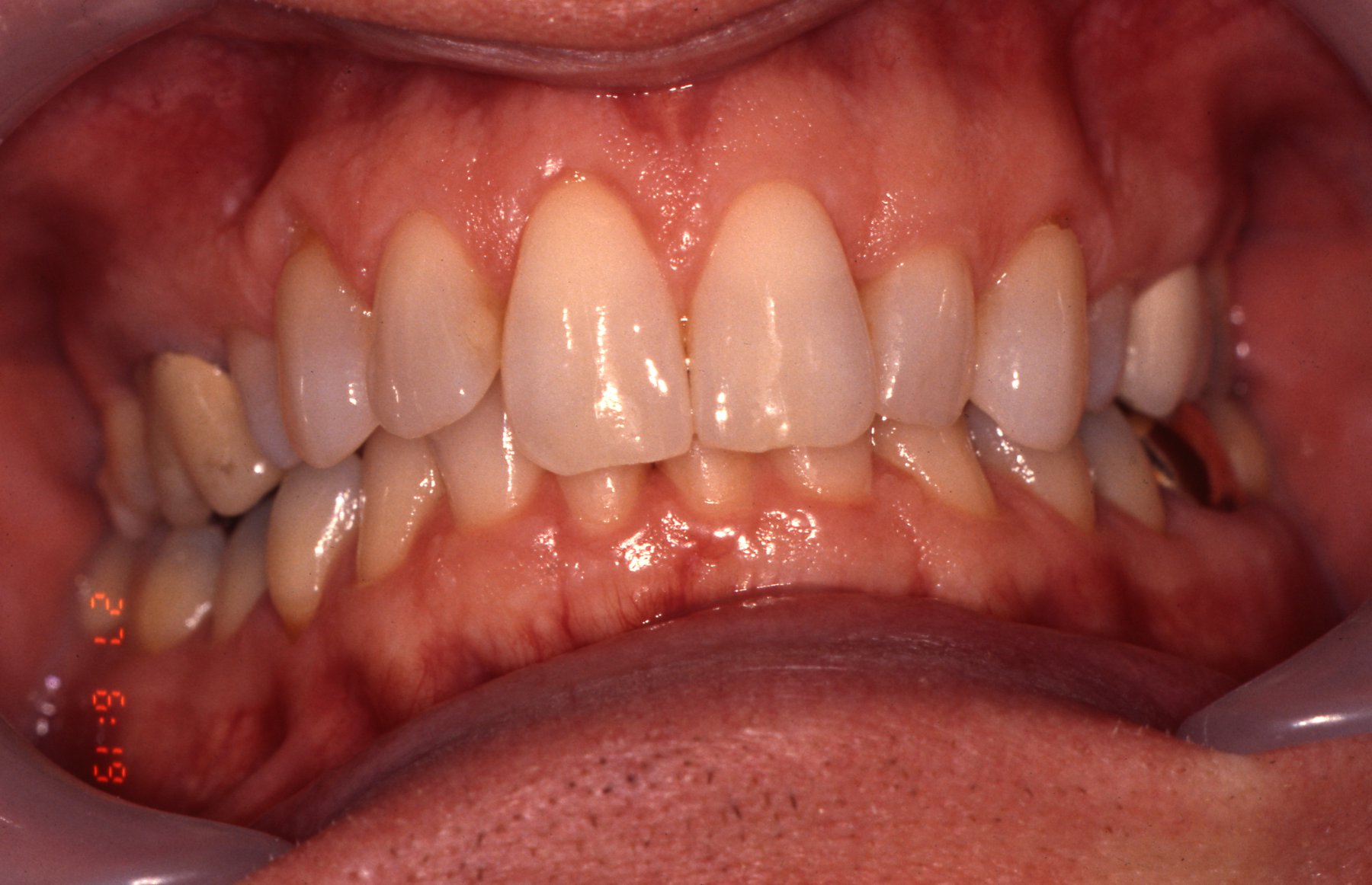teeth